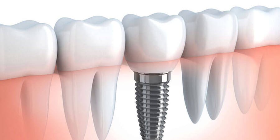 Dental Implants Edmonton